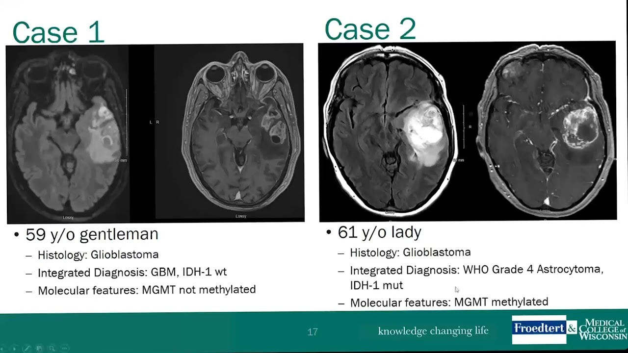 Neurosurgery Grand Rounds - Disappearing Spoon Disappearing Cancer Dr Connelly, MD 10 12 2023