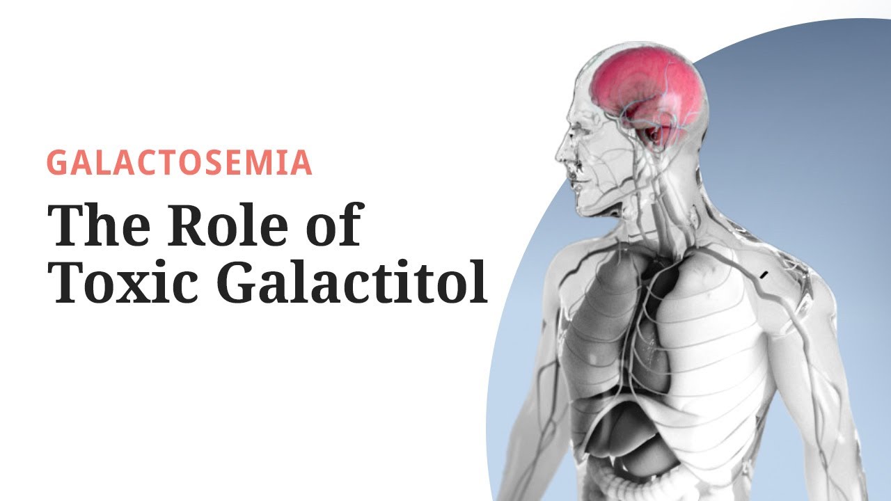 Galactosemia Pathogenesis: The Role of Toxic Galactitol
