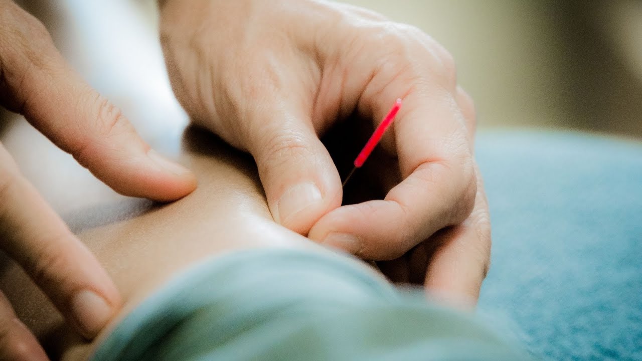Japanese Acupuncture Brisbane. What is Japanese Acupuncture?