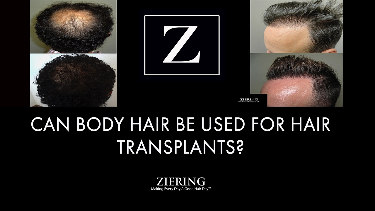Can Body Hair Be Used For Hair Transplants?
