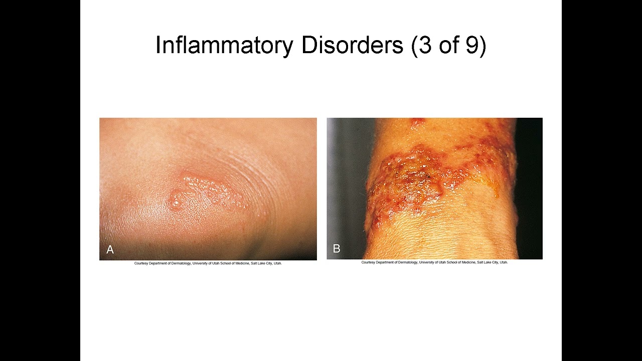 Integumentary System Disorders Explained: Psoriasis, Burns, Skin Cancer, and Infections