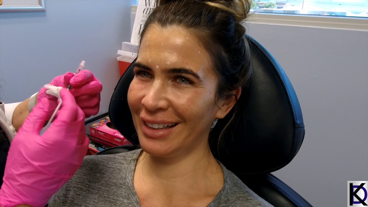 Dissolving Under Eye Filler with @AgostinaFitness