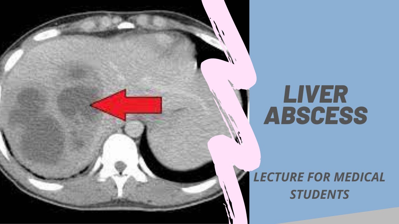 Абсцесс печени - Лекция для студентов-медиков #mbbs #neet #usmle #fmge #neetpg
