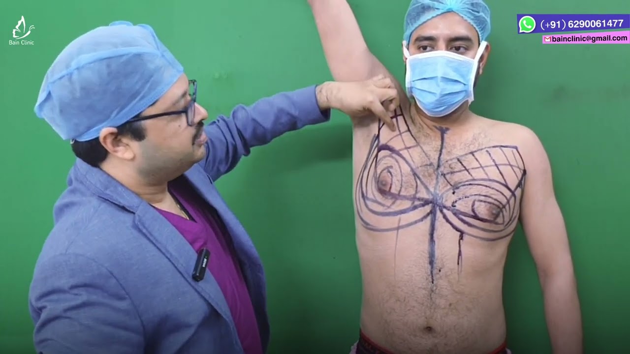 Gynecomastia Marking to Surgery By Dr. Jayanta Bain Plastic Surgeon | Kolkata
