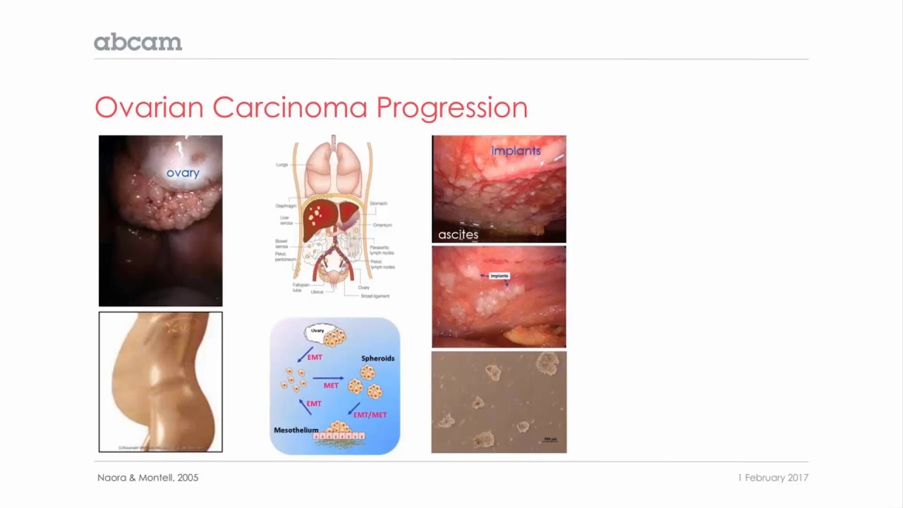 Cancer: Ovarian carcinoma (3/11)