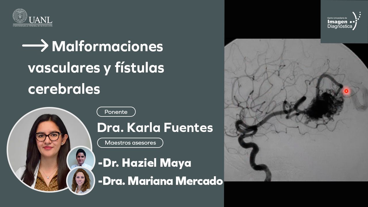 Malformaciones vasculares y fístulas cerebrales por la Dra. Karla Fuentes.
