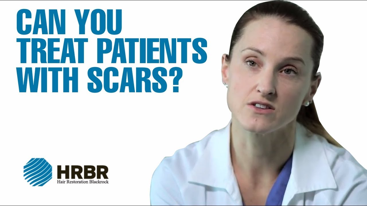 Can you treat patients with scars? - Hair Restoration Blackrock