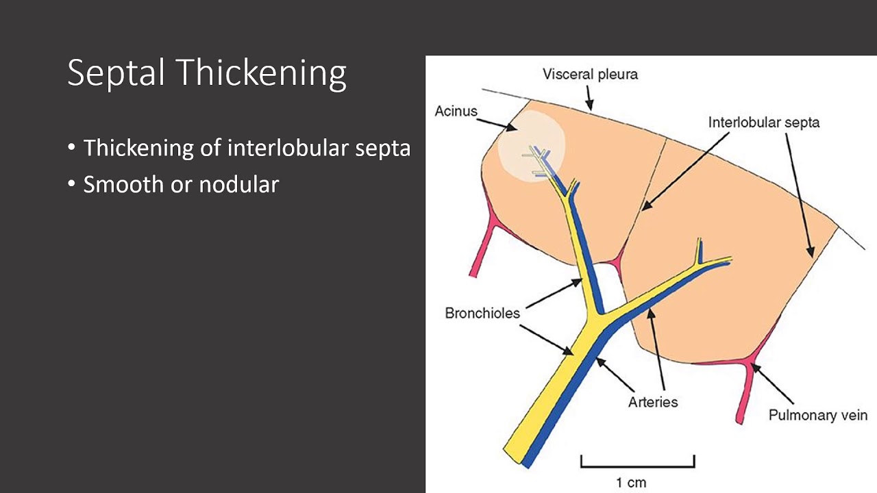 Terminology in CXR imaging