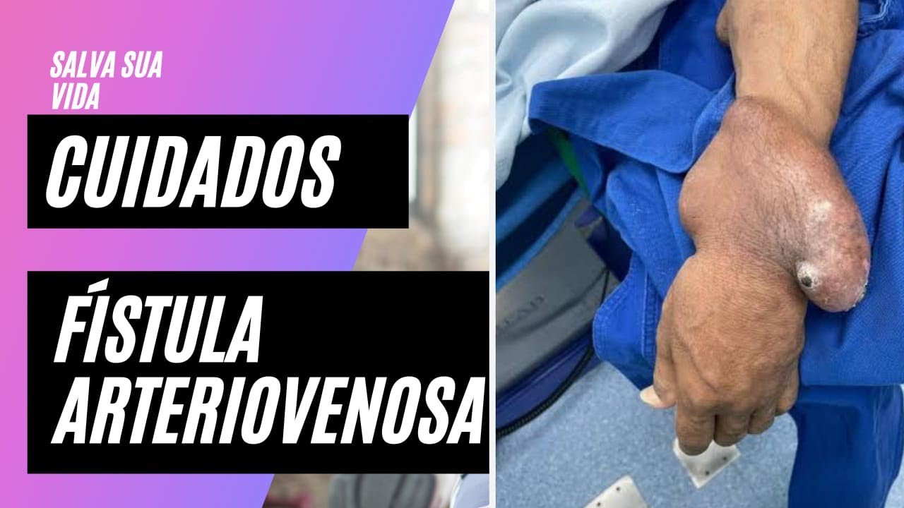 Cuidados com a FÍSTULA ARTERIOVENOSA