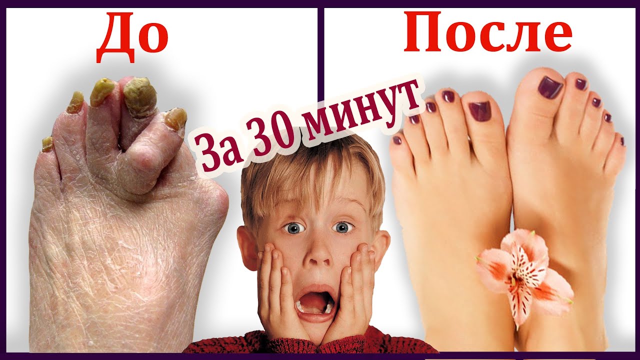 Смотреть всем! Эффективное лечение плоскостопия в Саратове. Индивидуальные ортопедическое стельки