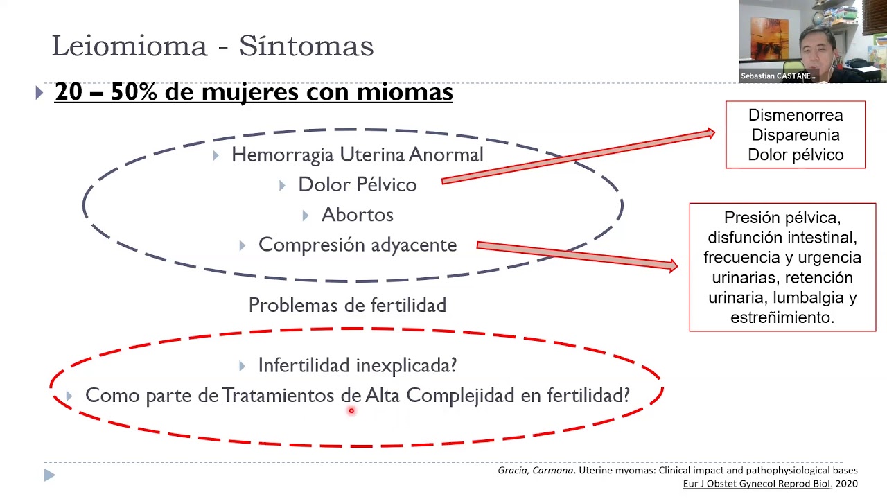 Miomatosis uterina y Coronavirus  - VID 02 ABRIL 2020