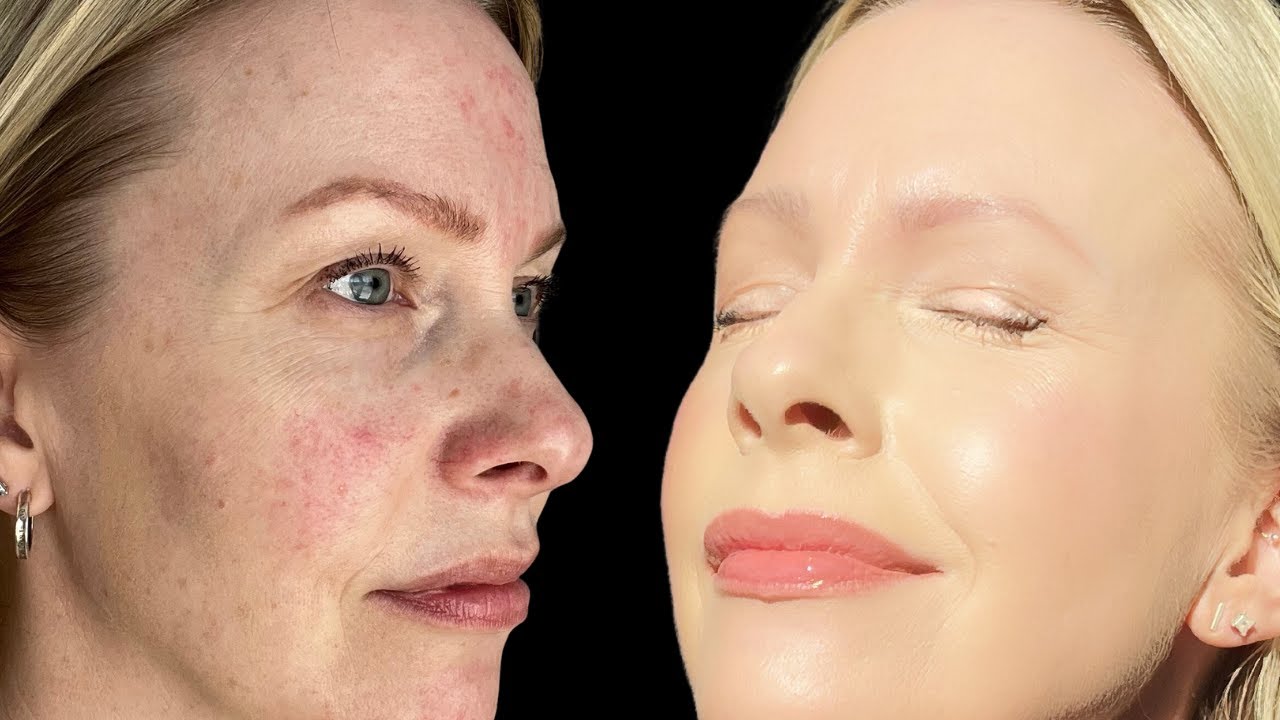 AZELAIC ACID Benefits for ROSACEA and HYPERPIGMENTATION 💜