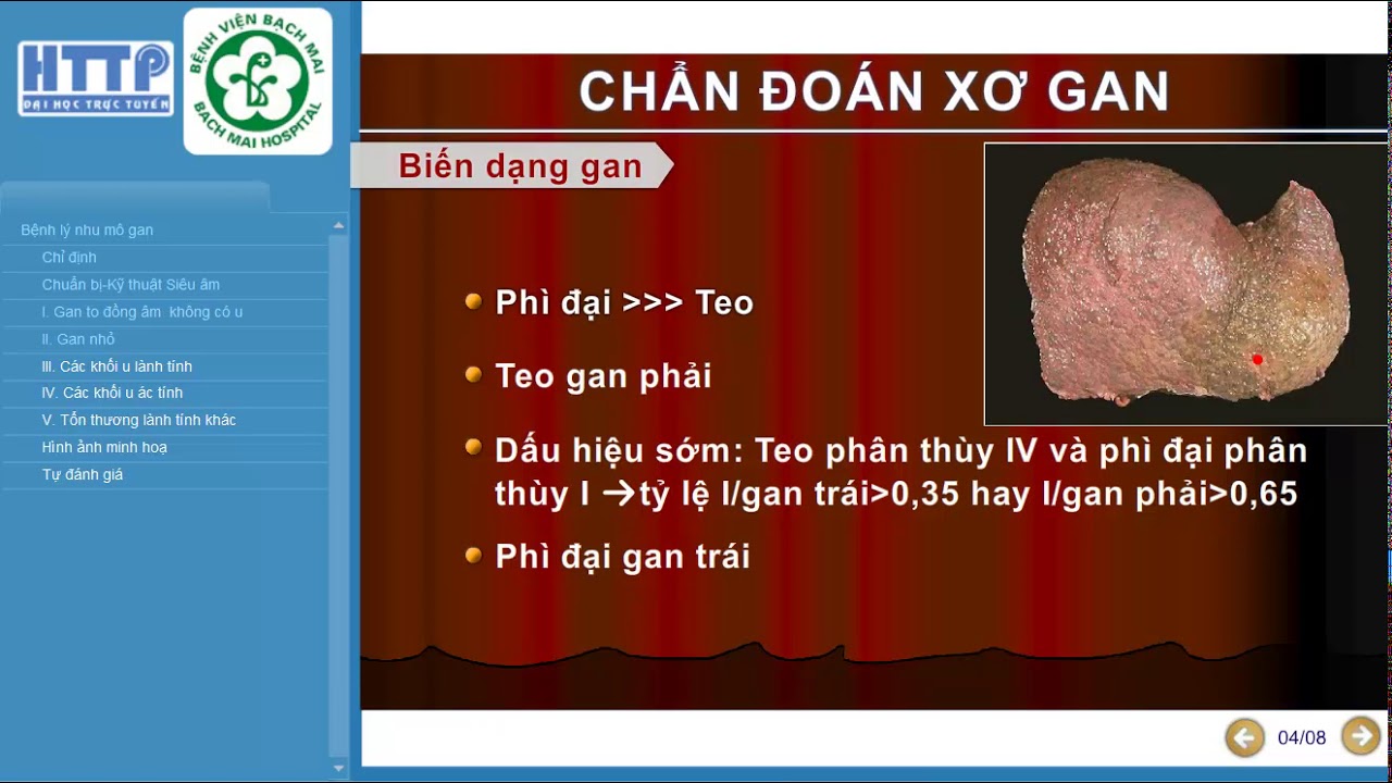 Bệnh lý Gan ( Siêu âm tổng quát ) Bệnh viện Bạch mai