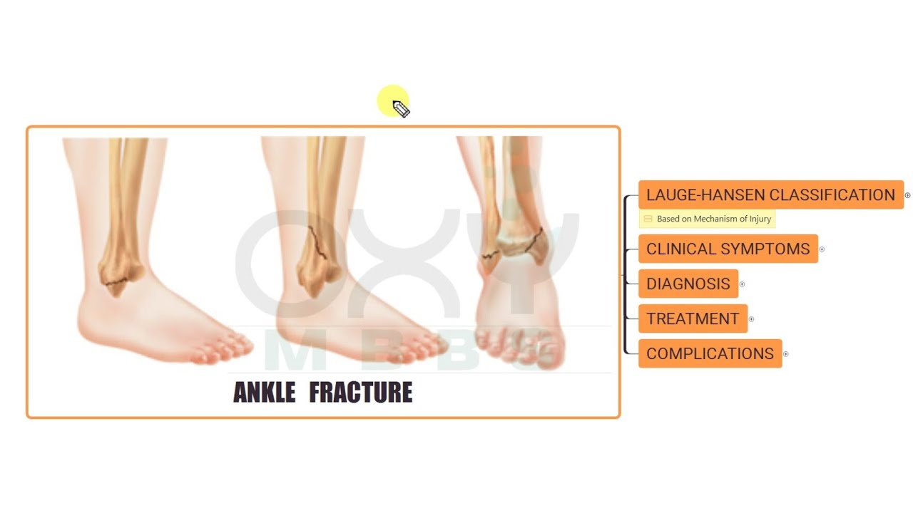 ORTHOPAEDICS- Ankle Fracture -2