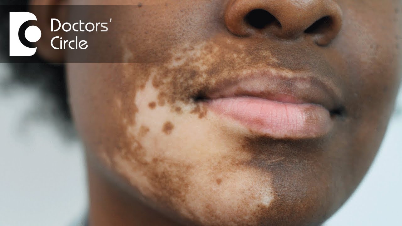 How can one get rid of acro facial vitiligo?-Dr. Rajdeep Mysore