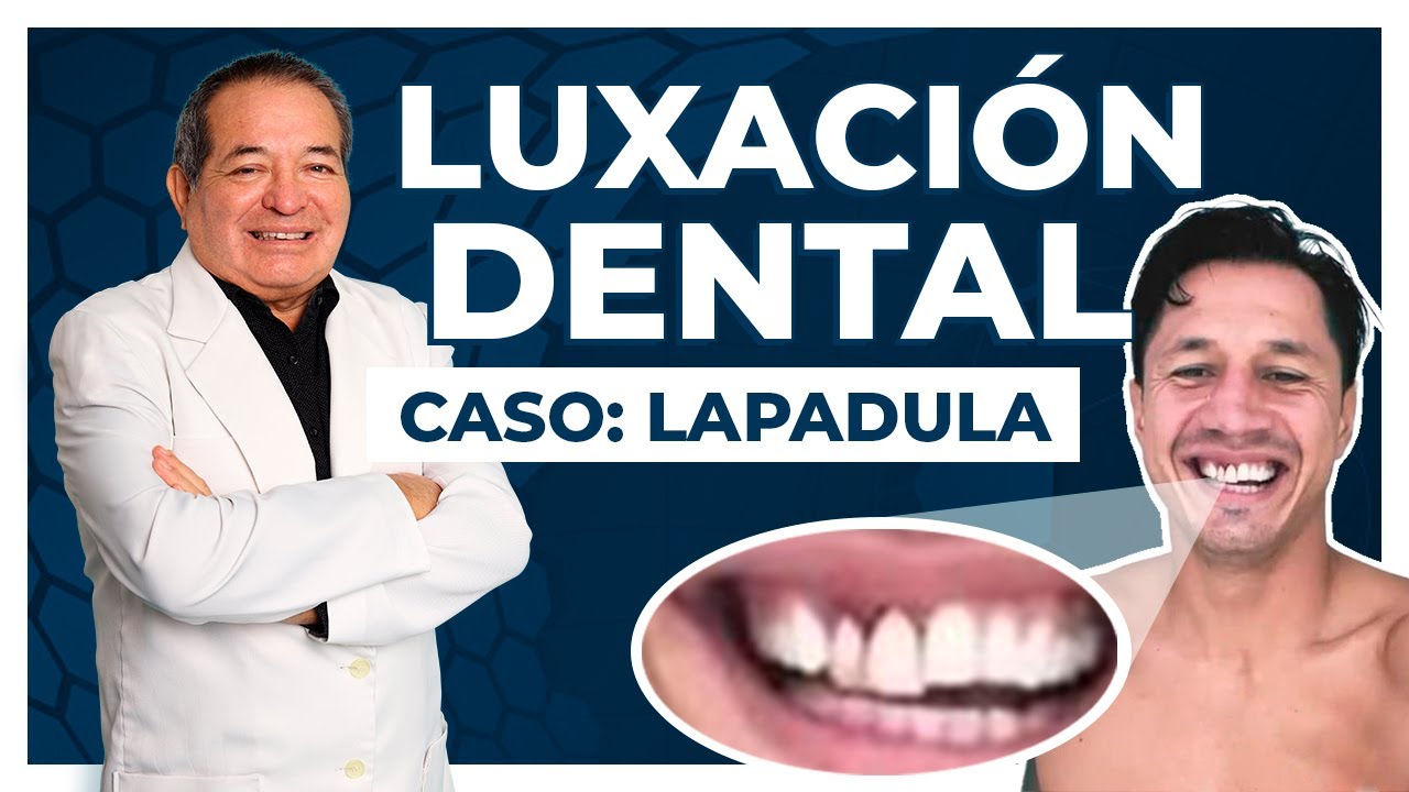 🦷| Luxación Dental - Dr. Jesús Ochoa