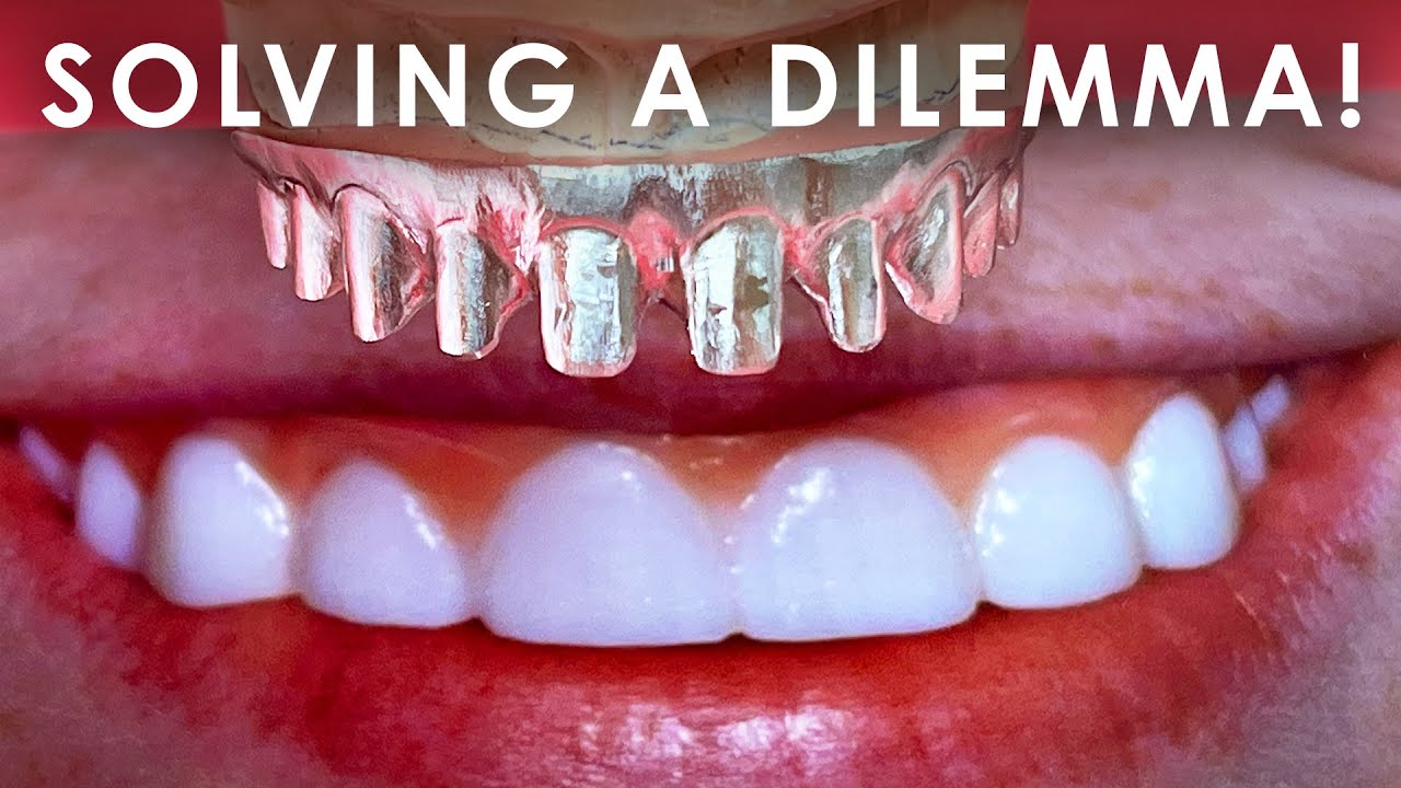 Solving a dilemma for a Full Mouth Implant Case