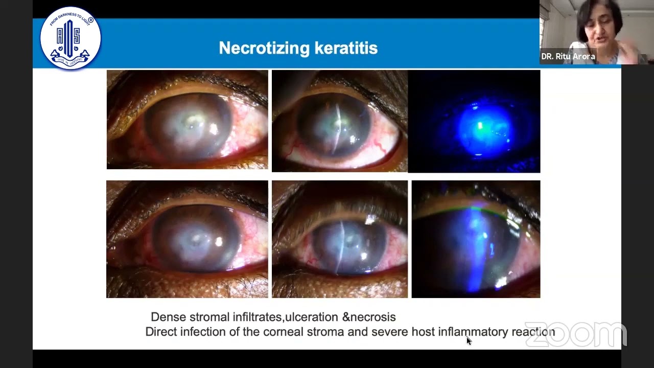 Attaining the Right Balance in Viral Keratitis Diagnosis and Management -Dr  Ritu Arora