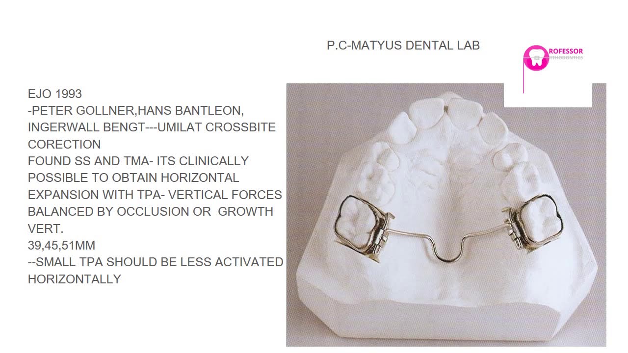TPA-  TRANS PALATAL ARCH - FABRICATION ,ANCHORAGE & OTHER USES # TPA #TRANSPALATAL ARCH