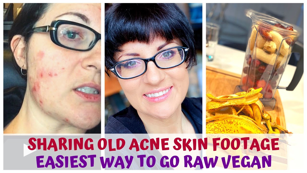 OLD ACNE SKIN FOOTAGE &bull; EASIEST WAY TO GO RAW VEGAN &bull; HEALTHY FOOD