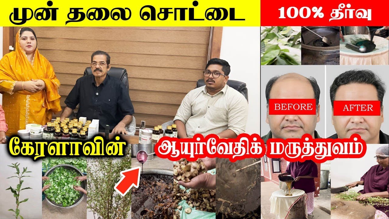 வழுக்கையில் முடி வளர இதை பண்ணுங்க 💯% ரிசல்ட் - vijayan master ayurveda hospital 