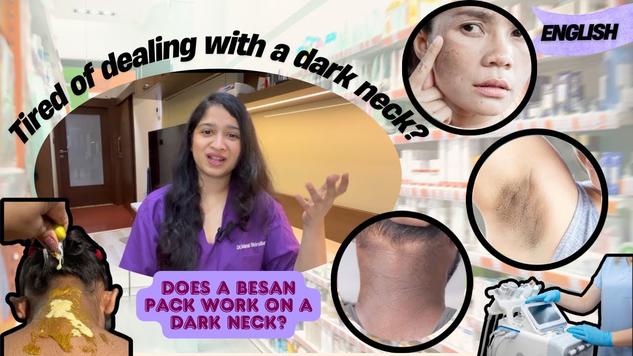 Get rid of Dark Neck | Causes, Treatments, Home Remedies & Best Creams, Skin Whitening Tips