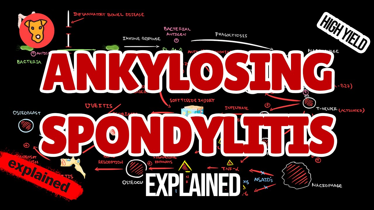Ankylosing Spondylitis Explained | Pathogenesis, Diagnosis & Treatment for Medical Students