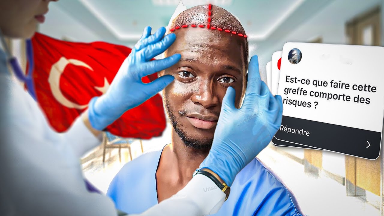 Je teste la greffe de cheveux en Turquie… voilà la vérité