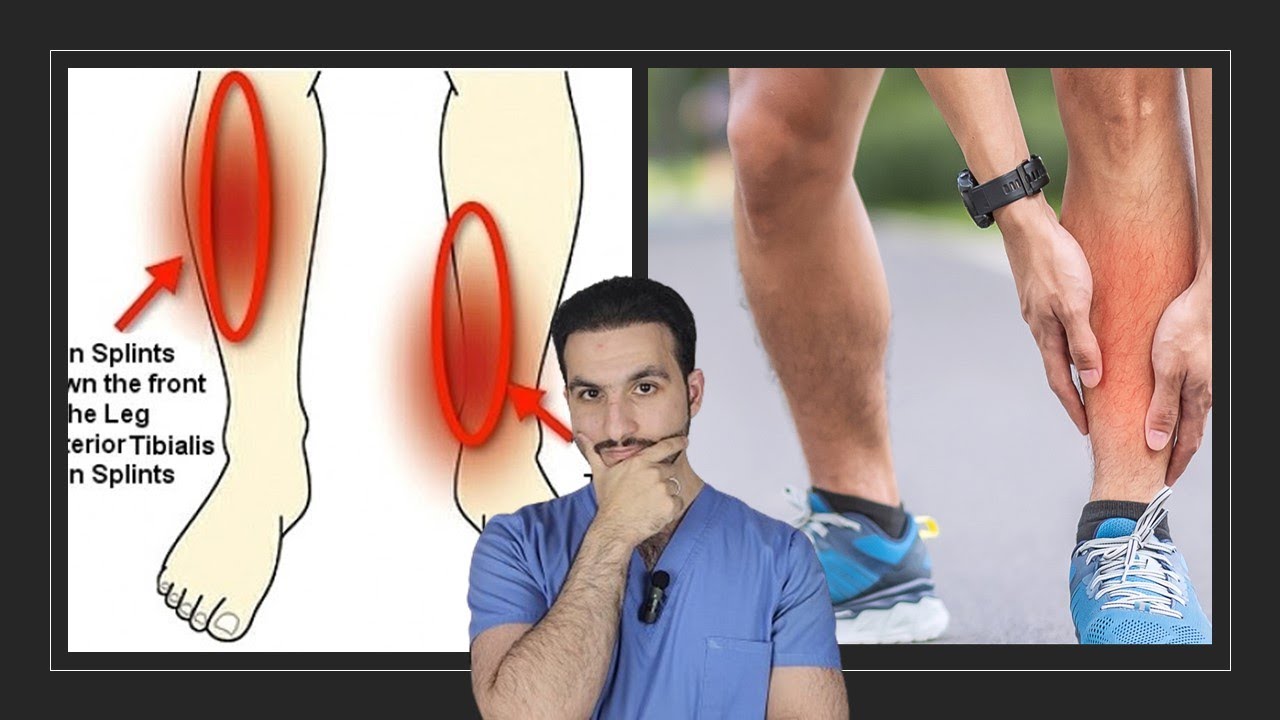 ألم في الساق من الأمام - متلازمة اجهاد عظمة الساق