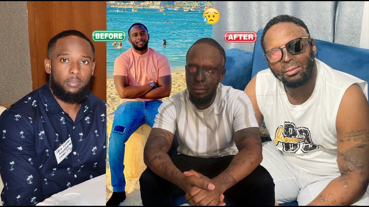 Inshuti ze zamusutse ACIDE mu maso kubera ISHYARI😭 UMUBIRI wamwihindutse mu isegonda| yari umusore m