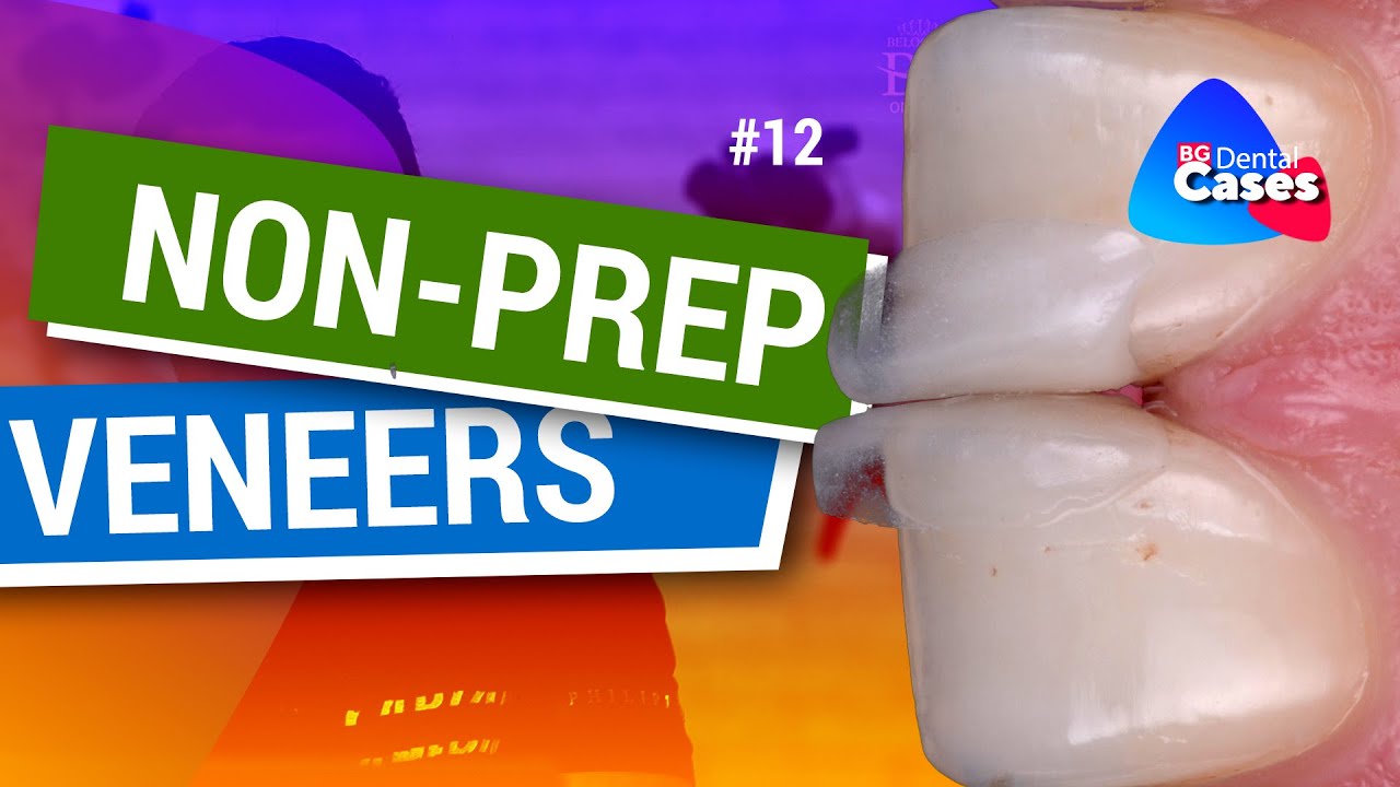 Non-prep veneers. BG Dental Cases 12