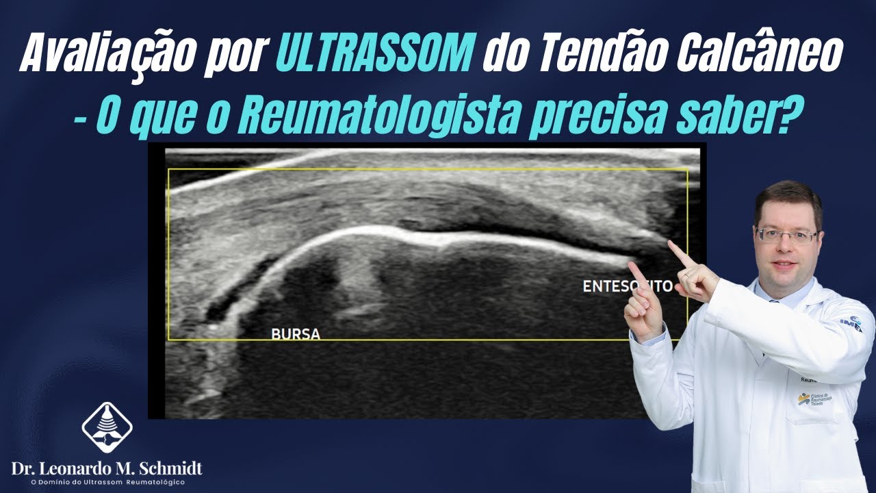 Ultrassom do Tendão Calcâneo - O que o Reumatologista deve saber?
