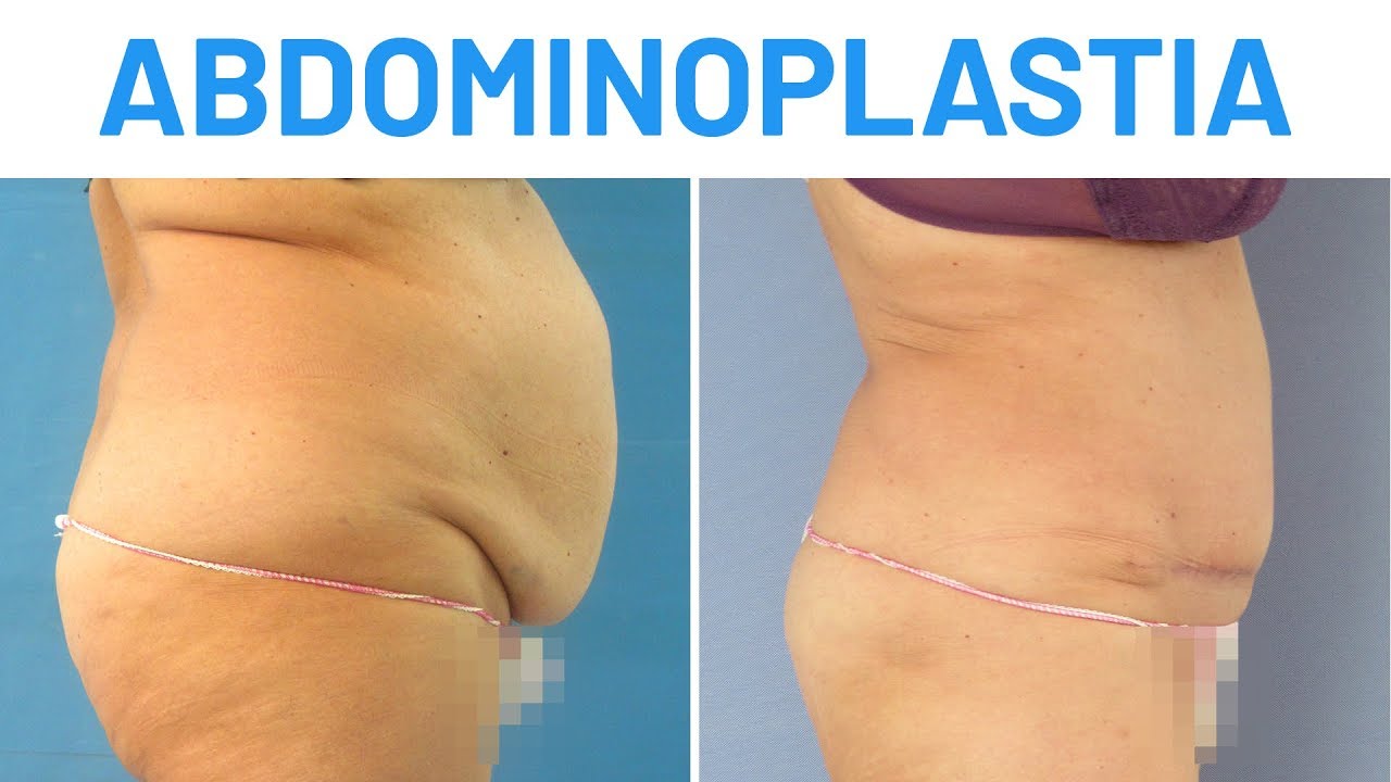 Abdominoplastia | Mi experiencia en Clínicas Diego de León
