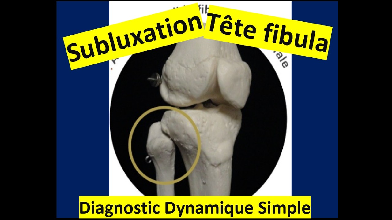 Subluxation Tête FIBULA : Diagnostic dynamique