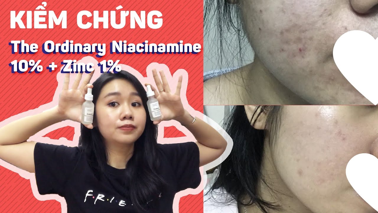 8 Tháng sử dụng THE ORDINARY NIACINAMIDE 10% + ZINC 1% - Có cả ảnh quá trình luôn