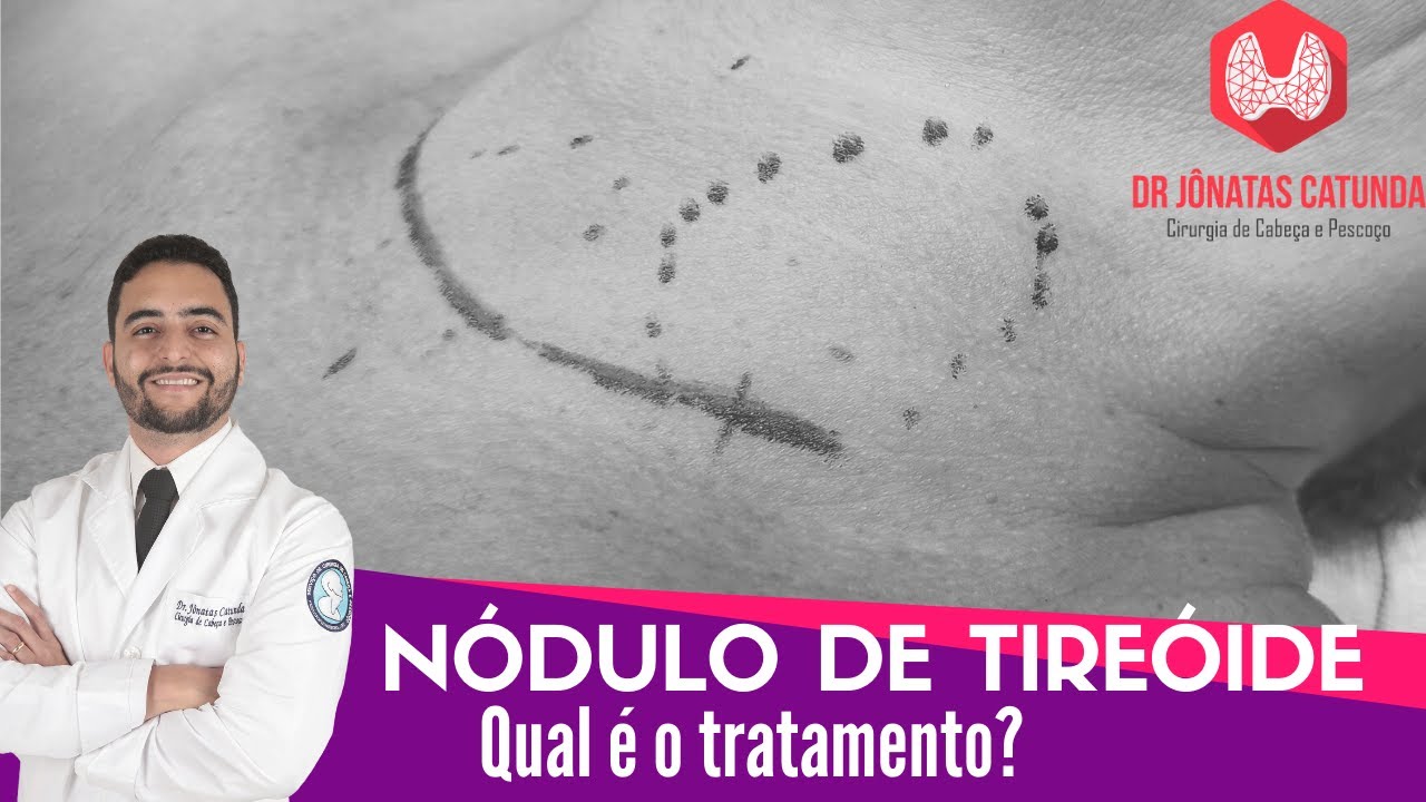 Como é feito o tratamento dos nódulos na tireoide?