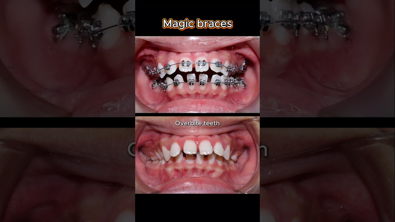 Braces for buck and gapped teeth. 32 months journey #braces #dentist #orthodontist #teeth
