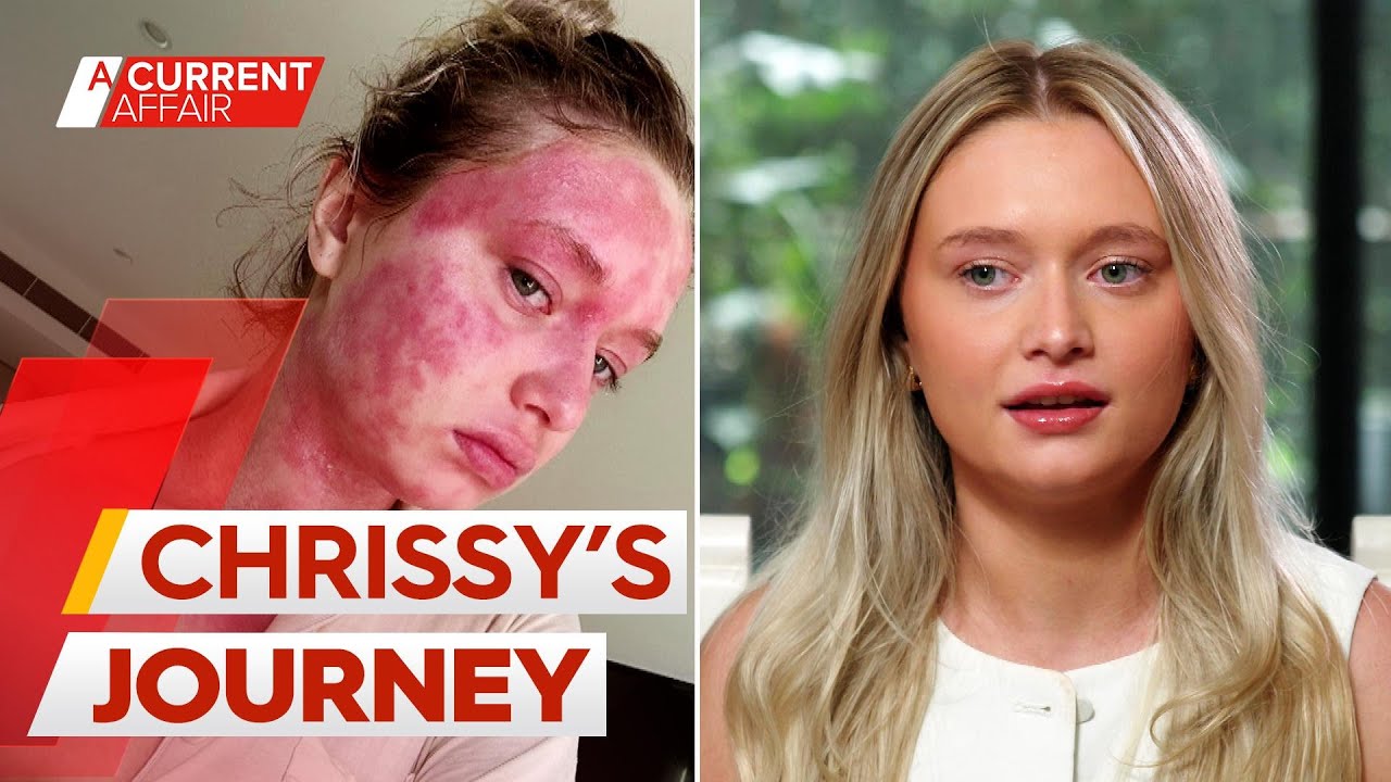 Arthritis drug clears woman's skin after 20-year eczema battle | A Current Affair