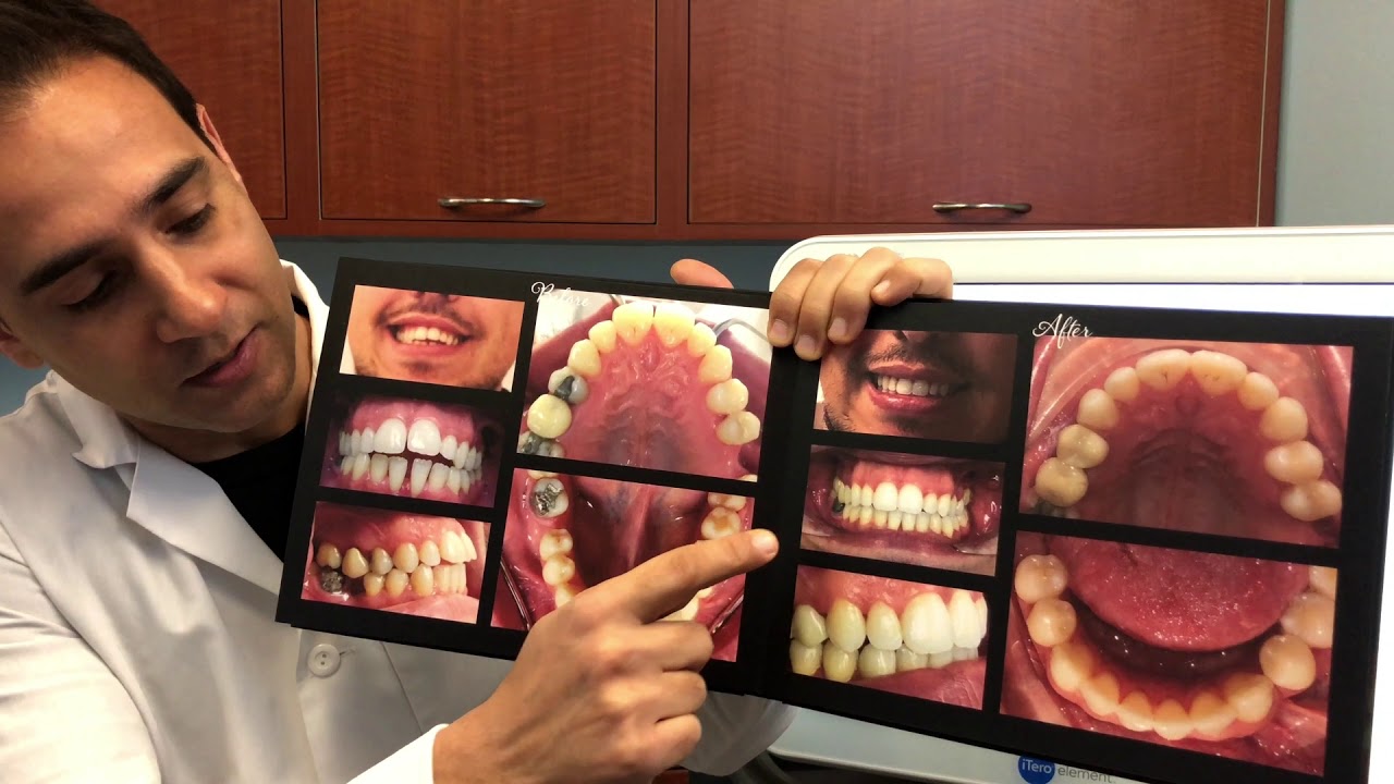 open bite Dr. Modiri