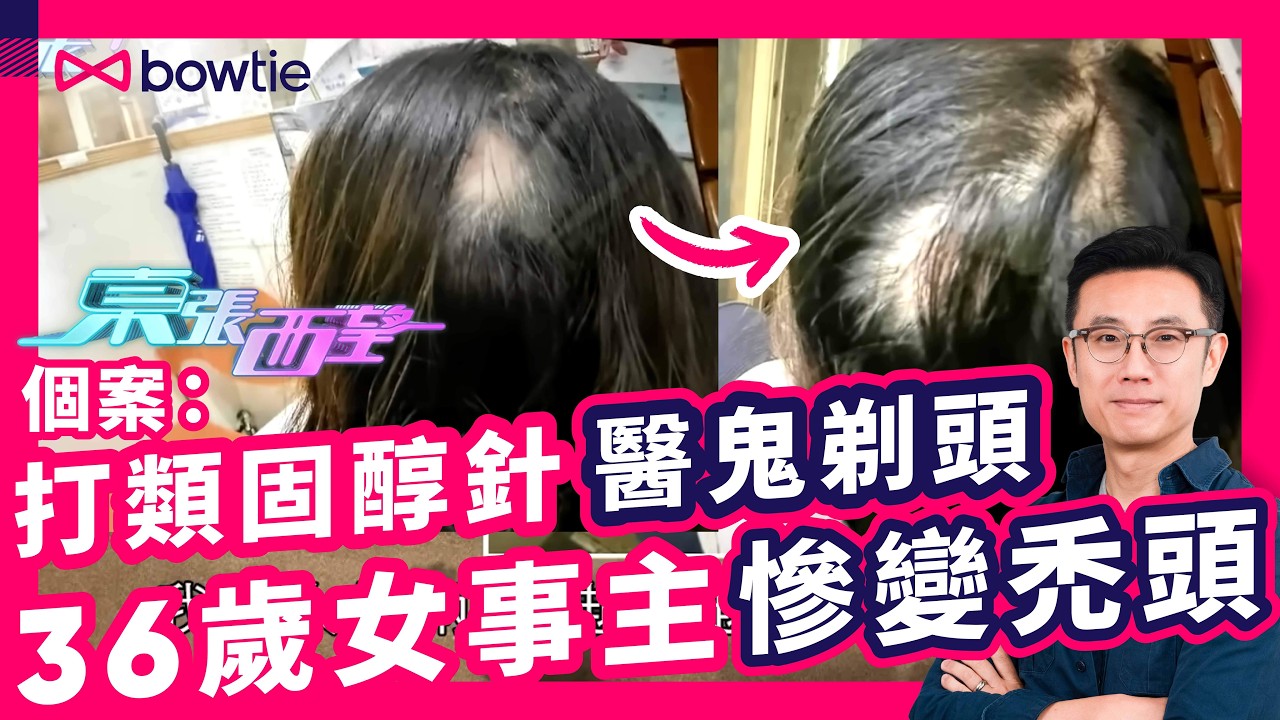 東張西望 禿頭 個案 ： 皮膚診所 類固醇 治療 「 鬼剃頭 」卻變 禿頭 ｜ 類固醇 治療斑禿 有咩 副作用 ？｜ 遇 醫療爭議 病人如何自保？｜#鬼剃頭 #類固醇 #斑禿 #Bowtie