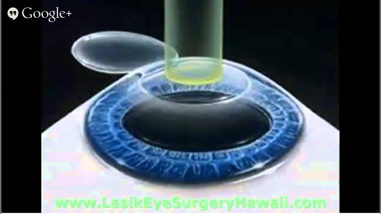 Cost Of Lasik Surgery In Hawaii 8083774101 Free Consultation