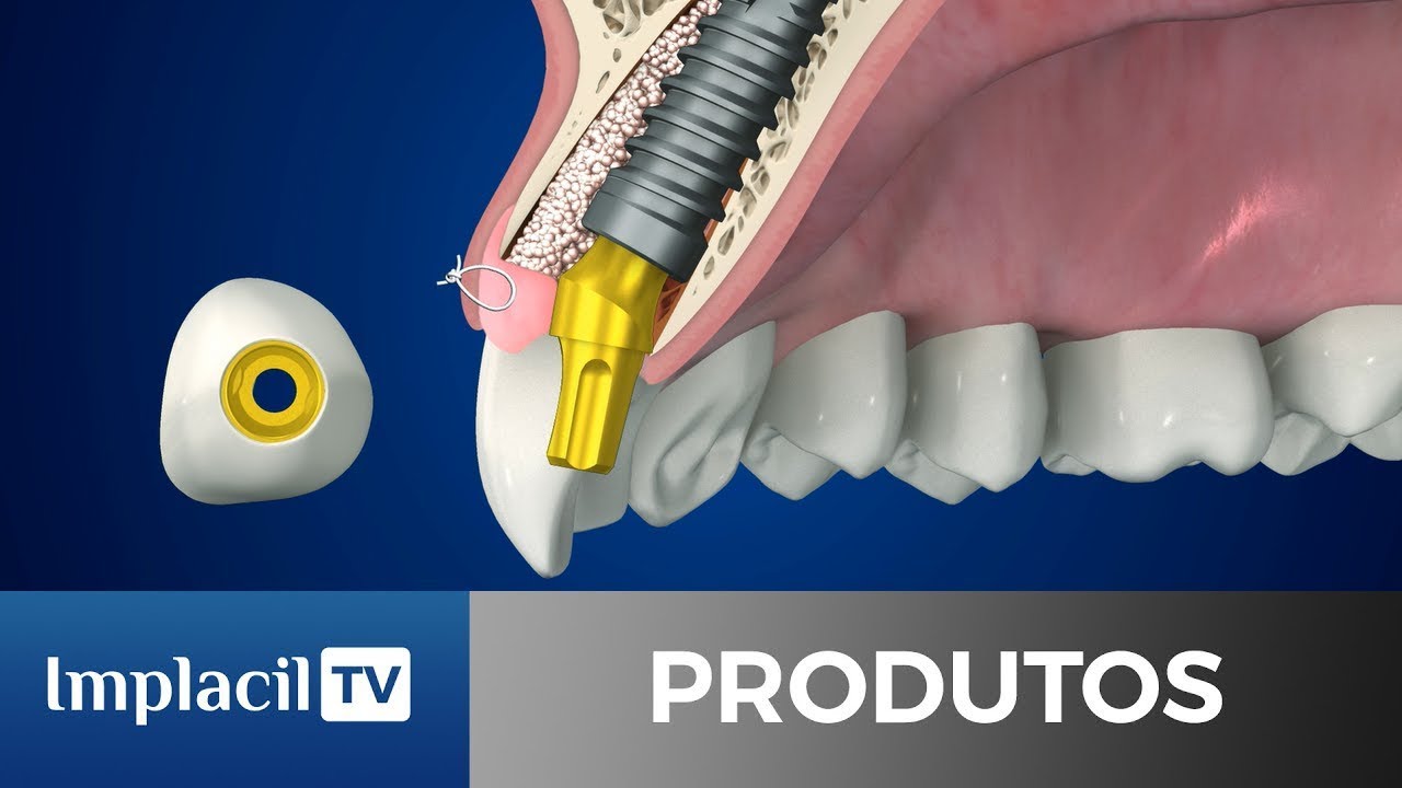LANÇAMENTO LINHA IDEALE | IMPLACIL DE BORTOLI