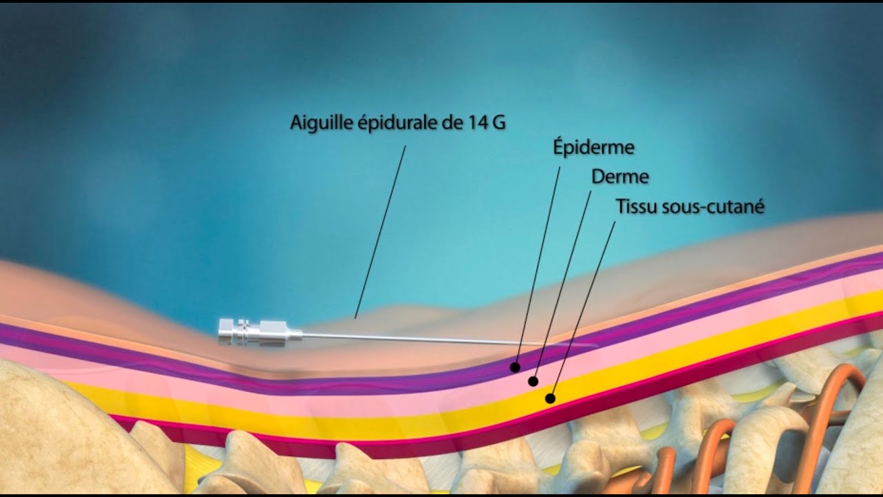La stimulation sous-cutanée dans le traitement de la lombalgie chronique