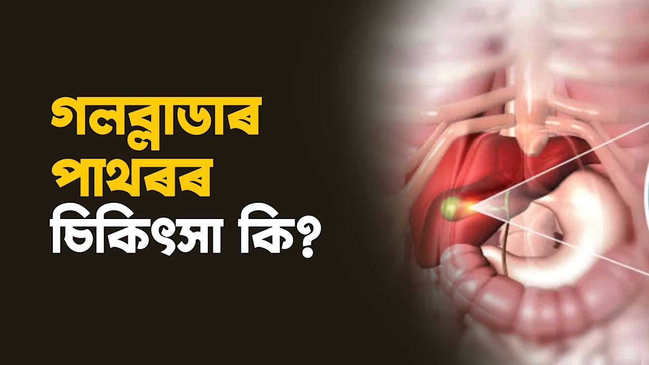 গলব্লাডাৰ পাথৰৰ চিকিৎসা কি?