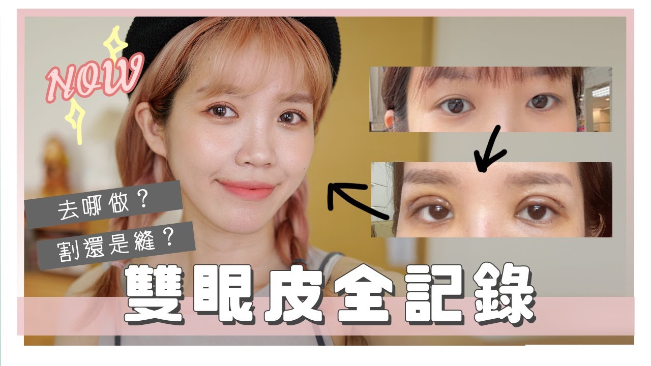 花7萬整形！雙眼皮+提眼肌手術全記錄！｜double eyelid surgery｜居妮Ginny Daily♥