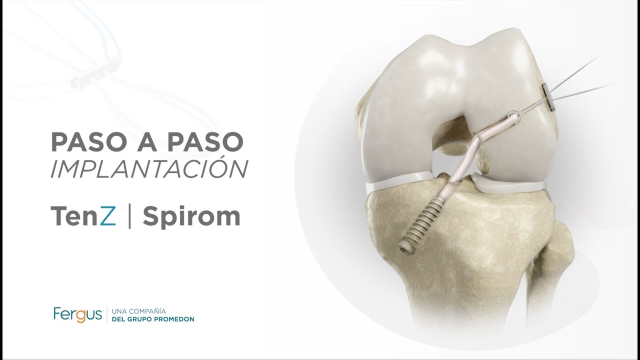 TenZ y Spirom - Implantación paso a paso