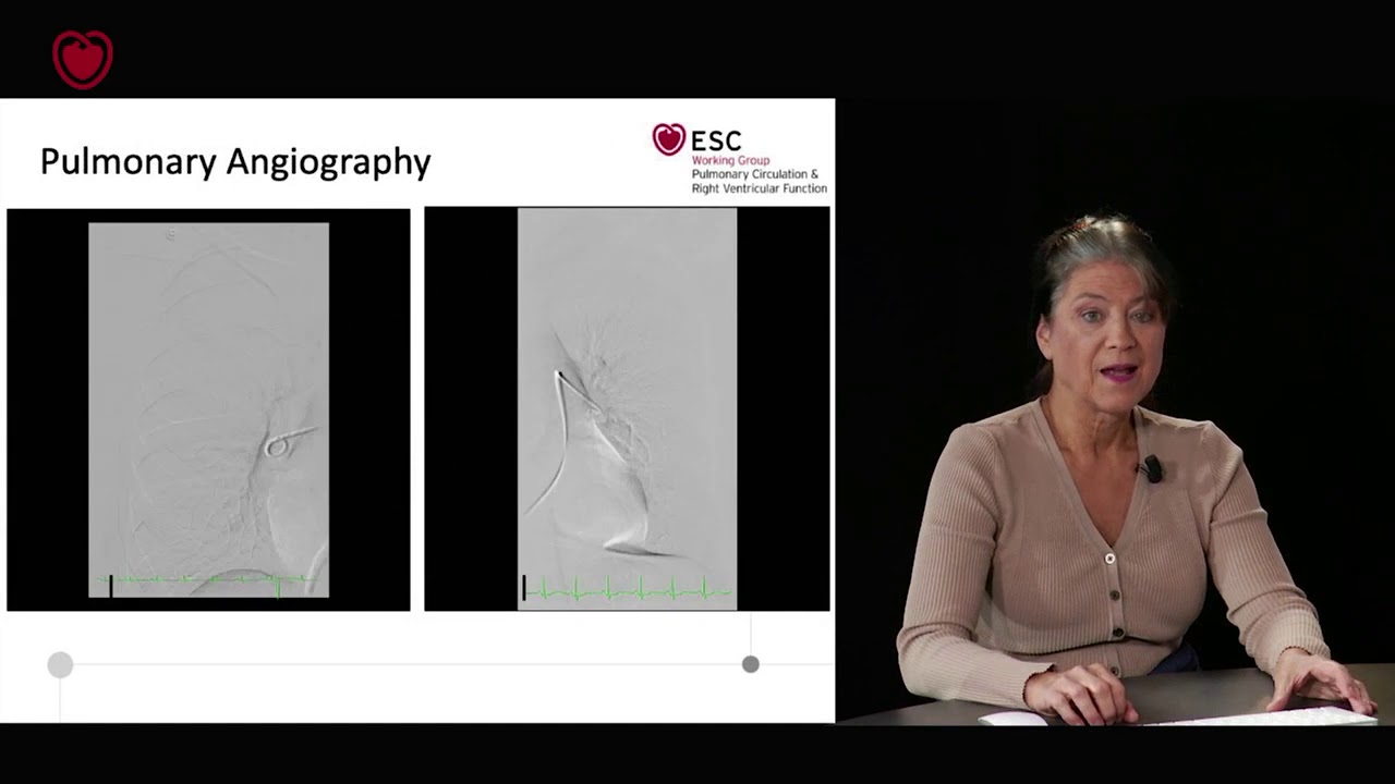 Pulmonary hypertension 2019: a roadmap for cardiologists. Webinar series, Part 2 of 2