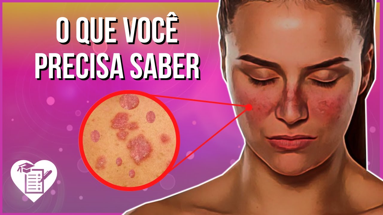 LÚPUS ERITEMATOSO SISTÊMICO - Causas, Sintomas e Tratamento