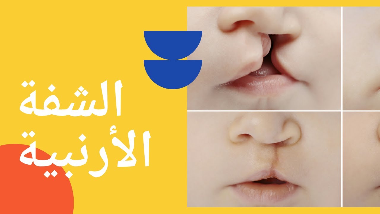 كل شيء عن الشفة الارنبية وشق الحلق