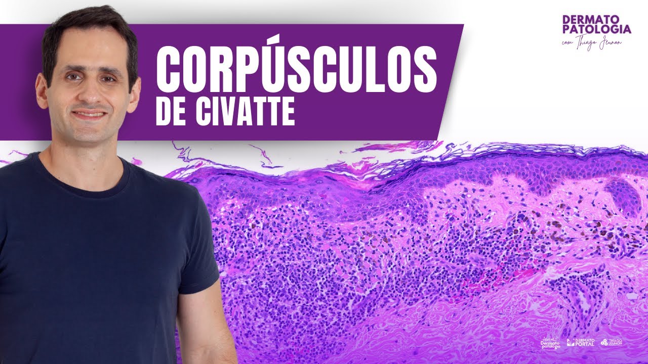 Corpúsculos de Civatte